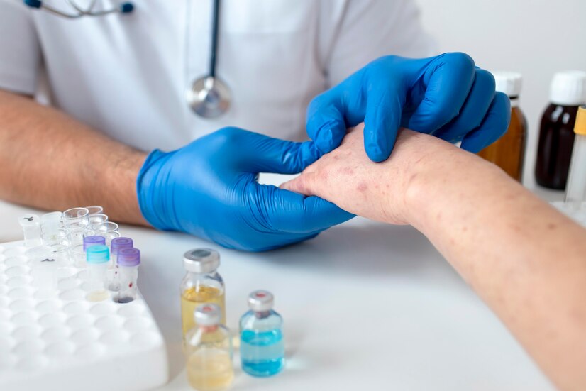 Exsudado Bacteriológico da Lesão